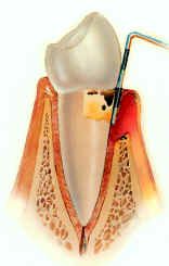 moderateperiodontitis.jpg