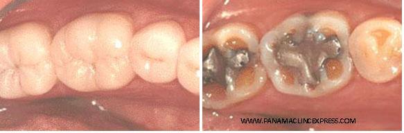 replace old amalgam filling