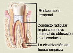 retreatment