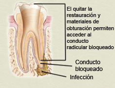 retreatment