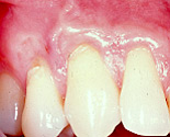 Periodontal Plastic Surgery