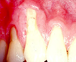 Periodontal Plastic Surgery