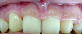 Crown Lengthening Procedure and Frenectomy