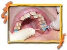 Replacing brace spacer using dental floss, Tucson AZ