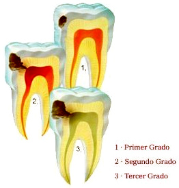 Caries