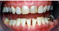 Crooked Teeth, Clipped Teeth, Discoloured Teeth Problem.