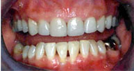 Porcelain Laminates with Teeth Correction Results in Non-Surgical Face Lift.