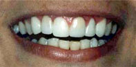 Porcelain Laminates with Root Canal Treatment.