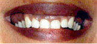 Excessive Gums with Blackish Pigmentation.