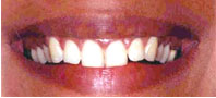 Crown Lengthening Surgery.