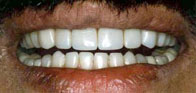 Full Mouth Rehabilitation, Tooth Bridges, Gum Treatment.