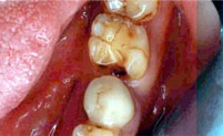 Before Dental Treatment - Gap Between Two Teeth.