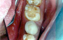 After Dental Treatment - Tooth Coloured Fillings.