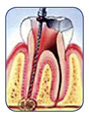 Determine lengty of root canals.