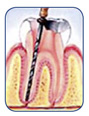 Remove unhealth pulp. Clean, enlarge, and shape canals. 