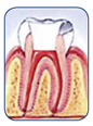 Fill and seal canals.