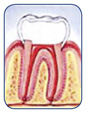 Seal tooth with temporary filling.